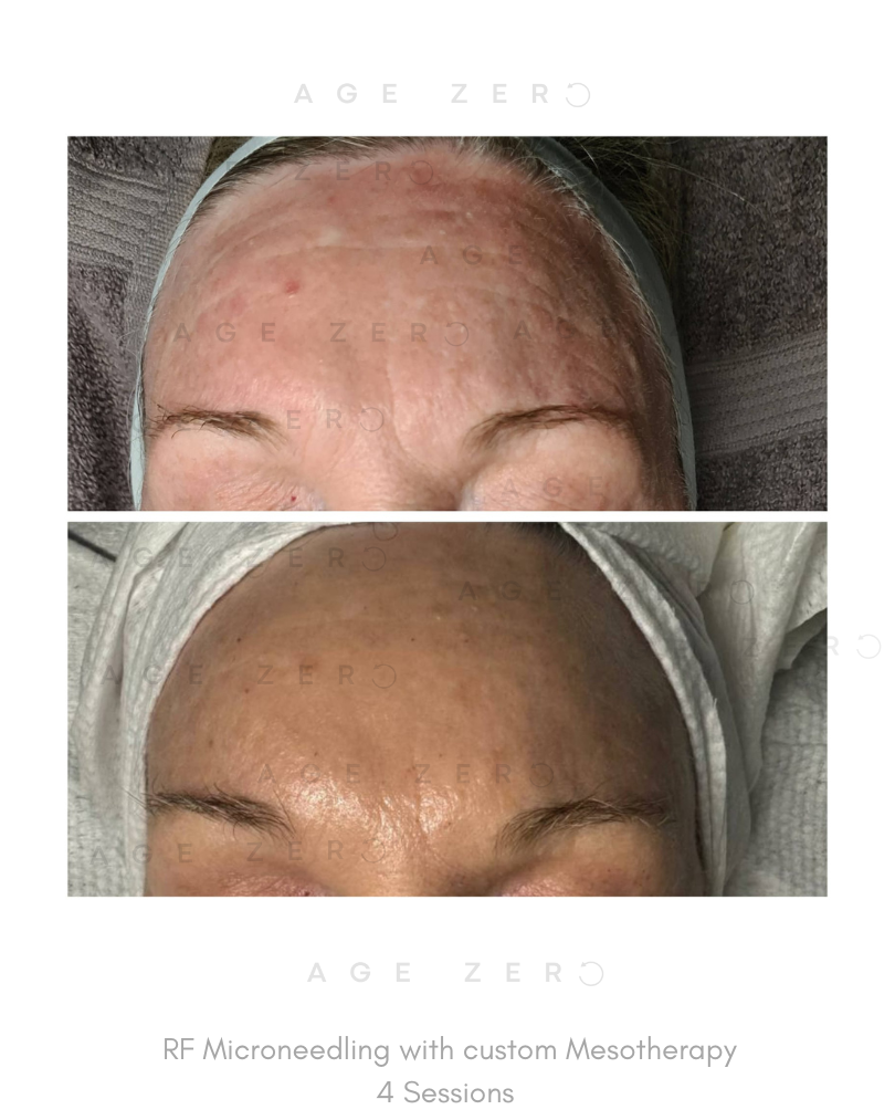 RF Microneedling 4 sessions.