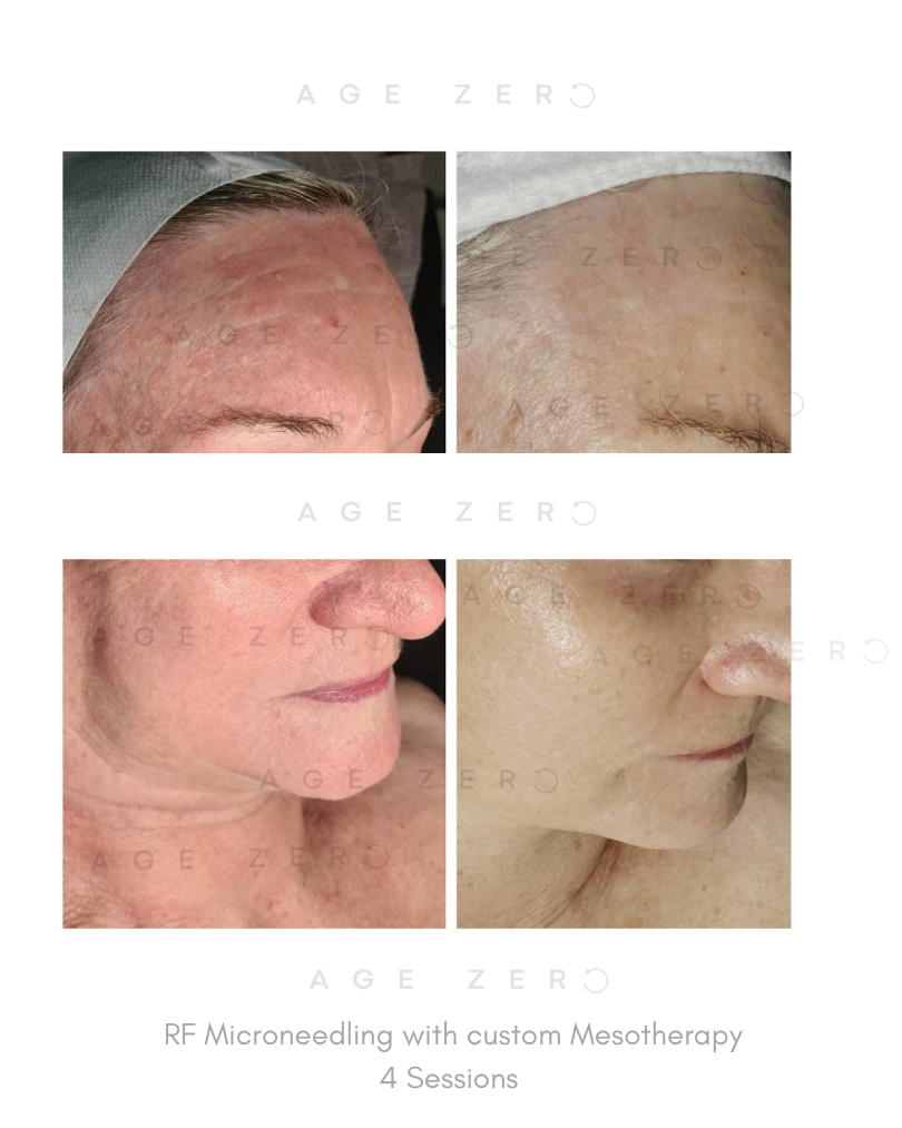 RF Microneedling 4 session results.