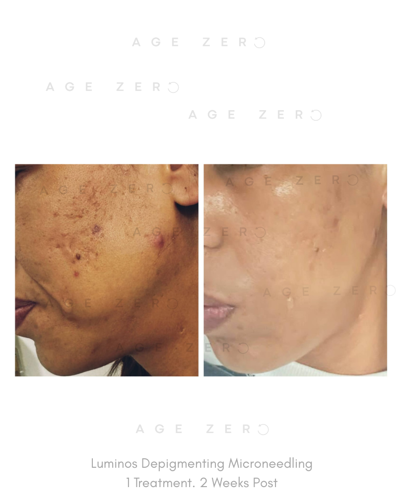 1 Session, 1 week post treatment.