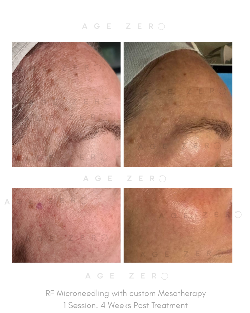RF Microneedling with custom Mesotherapy. 1 Session 4 weeks post treatment.