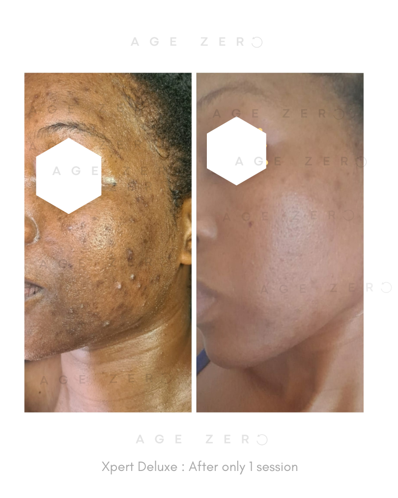 After 1 Xpert Deluxe one week post treatment.